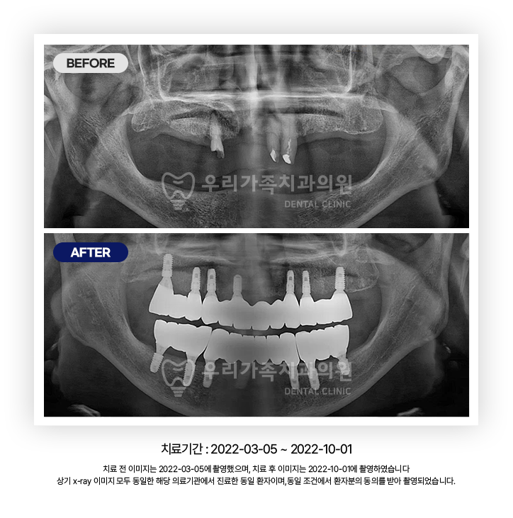 치과엑스레이사진